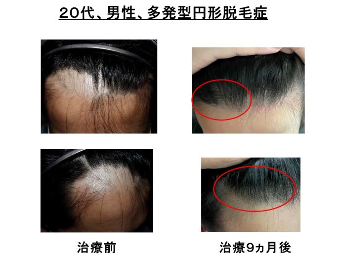 円形脱毛症　病院